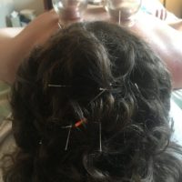 Cupping and Neuro-acupuncture