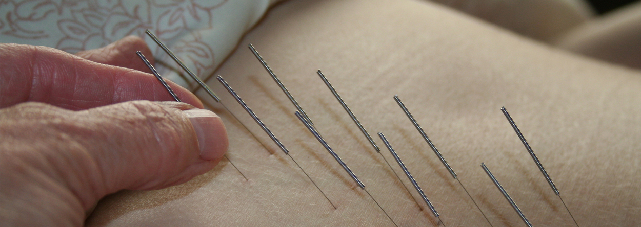 Acupuncture Cashmere